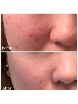 フルオール(FRUOR)/プラズマでニキビ肌卒業!!