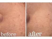 エムフルール(M fleur)/毛穴洗浄&美プレミアムコース