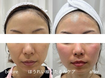 マイ フェア レディ(MY FAIR LADY)/たるみ・引き締めケア