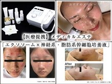 エクソソーム導入で毛穴の開きやシミしわ肌悩みの改善へ！