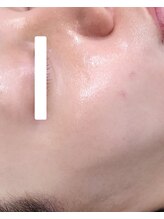 ココホワイトニング(coco whitening)/【20代男性ハーブピーリング】