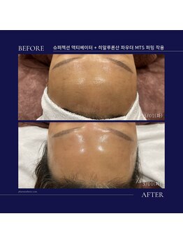 トータルクリア(TOTAL CLEAR)/韓国高級エステ「SUPERJECTION」