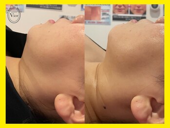 ヴィオール 名古屋栄店(VIOR)/効果実感大◎ 施術1回!