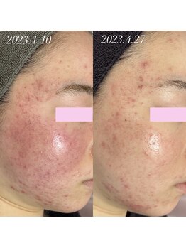 スピカ(Spica)/バクチ甦生プログラム