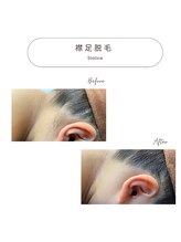 スターチス(Statice)/襟足脱毛　ビフォーアフター