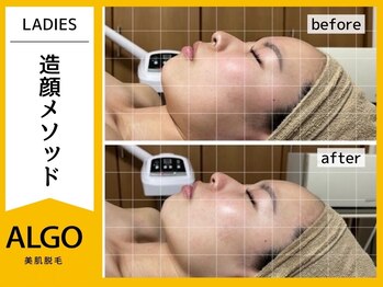 アルゴ 小松店(ALGO)/北陸初！韓国式造顔メソッド★