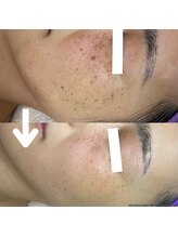 ソイ(Soi)/長年のシミもお任せ下さい♪