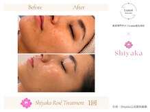 ルミエ 恵比寿店(Lumie)/ロゼピーリング症例