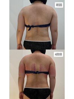 ヴォアール 東静岡店(VOIR)/1.5ヶ月コース途中経過