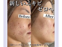 ネムレル森(Nemureru森)/ハーブピーリング