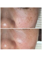 ソワラ(Soiela)/肌質改善