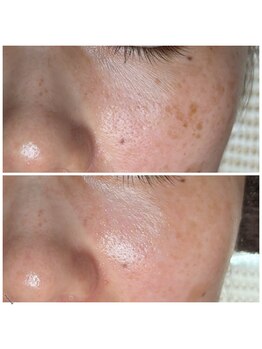 ソワラ(Soiela)/肌質改善