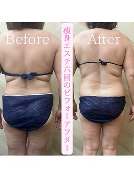 介正鍼灸整骨院 整体院 エフコープ大野城店/痩身エステ＊ビフォーアフター