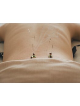 鍼灸施術を受けたい