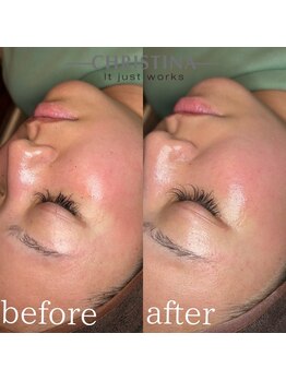 イデアル(Ideal)/UNSTRESS乳酸菌ピーリング