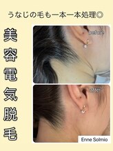 エンネソルミオ(Enne Solmio)/広島で希少の美容電気脱毛☆