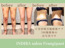 フランジパニ/【インディバ☆美容吸引後ケア】