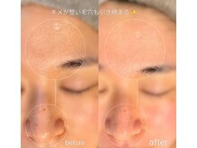 ラ メール(La mer)の雰囲気（雪花ピール効果☆透明感ある艶肌へ。毛穴悩みに特化!!）