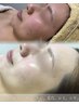 本気の肌質改善！様々な肌トラブルに◎〈TIP ハーブピーリング〉