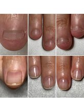 トレフル(Trefle)/噛んで極度に小さくなった爪が