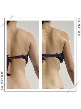 スキンホリック 恵比寿駅前店(SKIN HOLIC)/背中☆ビフォア＆アフター★