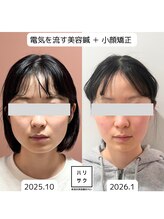 ハリサク/【症例写真】3ヶ月before→after