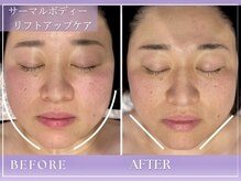 アンフィニテ(ANFINITE)/リフトアップフェイシャル