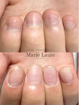 マリーロール 梅田店(Marie Laure)/自爪育成/深爪矯正/ネイルケア