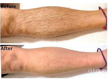 セラス(CERAS)/男性の足脱毛