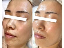 エクレ(eclat)/剥離なし＊ハーブピーリング