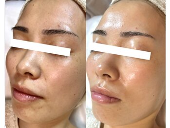 エクレ(eclat)/剥離なし＊ハーブピーリング