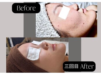 ミシェル(Michelle)/ニキビケア施術前と施術後