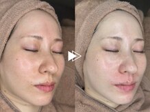 【毛穴・ニキビケア】開いた毛穴とニキビ予防を同時に叶えるララピール+白玉orLDM11000円【毛穴洗浄】