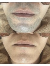 アカラ 読谷店(AKALA)/ヒゲ脱毛3ヶ月経過