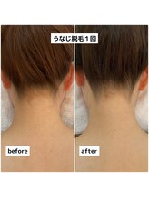 プレヴェール 神戸三宮/うなじ脱毛