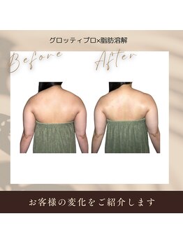 ボディケアサロン アイリフ(airef)/グロティプロ×脂肪燃活 2回