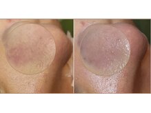 レンリー(Renry)/毛穴のボツボツ、見た目が変わる