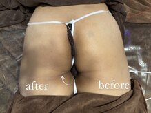 ビノスビューティー(vinos.beauty)/症例写真　ヒップアップ