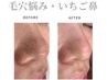 【毛穴・黒ずみ・角栓ケア】いちご鼻改善フェイシャル