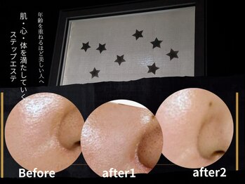 ひぺりかむの写真/1日目・RFで緊張緩和☆2日目白玉スノーピールで「水光肌」体験！首・肩からお顔へアプローチ！