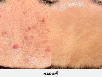 ナルムフェイシャル 代々木(NARUM facial)/エクソソームハーブピーリング