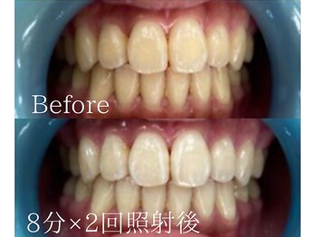 ホワイトニングカフェ アスピア明石店(WhiteningCafe)/◎歯のホワイトニング施術写真◎