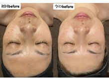 ディサイドロー(DECIDE L.A.W)/エステの真相