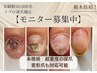 栃木県初【再発させない深爪矯正】即日見た目改善¥23100→モニター価格¥12900