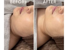 シルキーエービューティー(Silky A Beauty)/小顔マシン