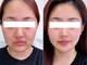 エステ ラミ(Esthe' l'ami)の写真/新潟県初導入！最先端小顔マシンで理想のフェイスラインへ◎小顔効果で見た目年齢-５歳を目指す！