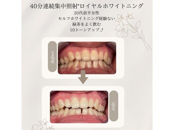 プラスビーセルフ(+b self)/ホワイトニングビフォーアフター