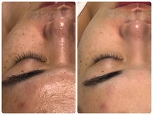 ベルドア(Bell Door)/【基本のニキビケア】