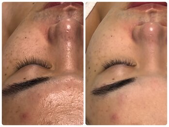 ベルドア(Bell Door)/【基本のニキビケア】