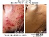 【 ハーブピーリング 】 部分ニキビケア ◎　トーンアップ ◎ ¥11,000